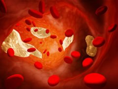 Высокий холестерин в крови у женщин: причины и симптомы повышенного уровня, чем понизить