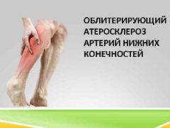 Облитерирующий атеросклероз нижних конечностей