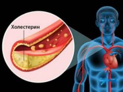 Холестерин в сосудах фото